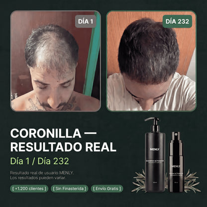 Protocolo contra la alopecia | Recuperá tu pelo sin efectos secundarios.